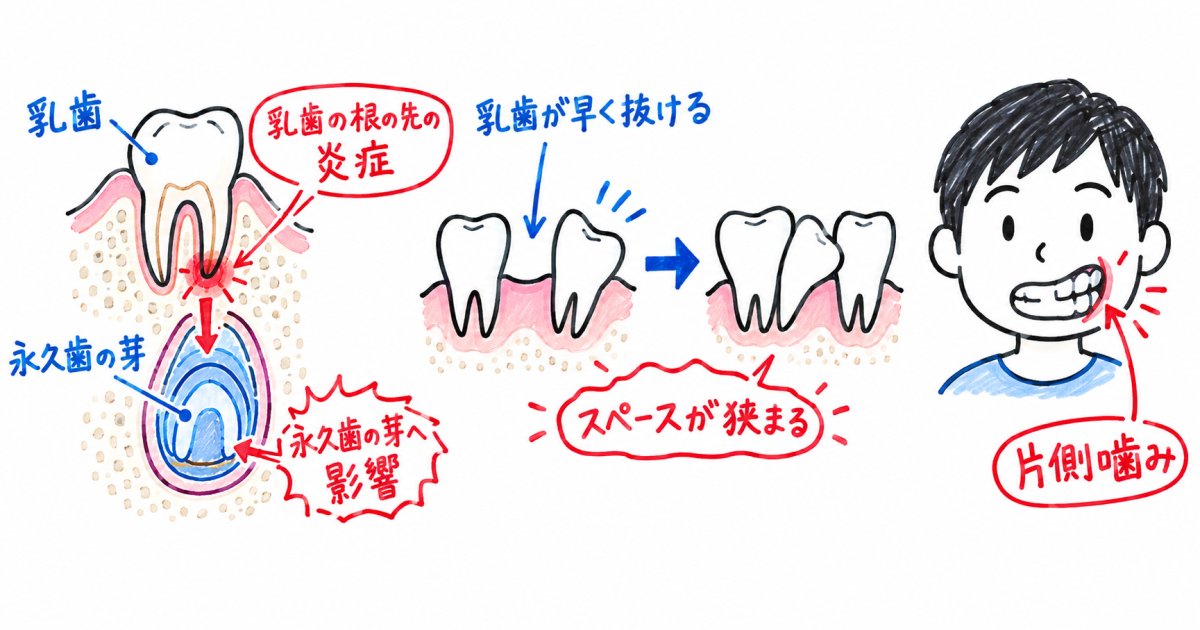 乳歯のむし歯放置が永久歯や歯並びに与える具体的な影響